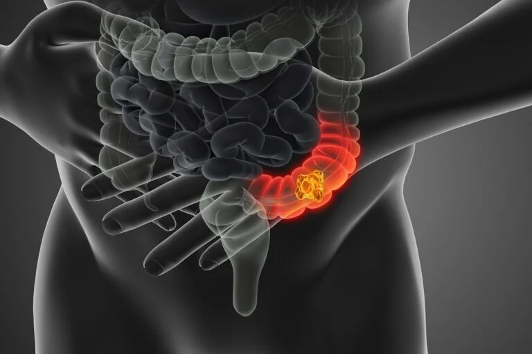 Modelo_Cancer_Chip_Estudo_Cancer_Colorretal_UPM-768×512